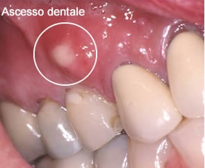 Ascesso Dentale Punti Chiave Studio Dentistico Arioli